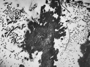 F,17y. | dystrophic calcification in a glial scar F,17y. | dystrophic calcification in a glial scar